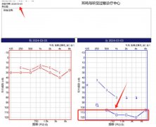 中医有特色 西医有优势|突聋+耳鸣患者坚持再次入院治疗，这究竟是为何？