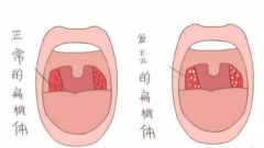 扁桃体炎的治疗方法有哪些