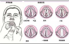 声带息肉患者的饮食注意事项