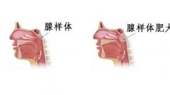 重庆看耳鼻喉医院哪里好—儿童腺样体肥大的特