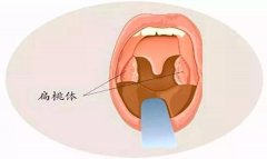 扁桃体炎什么时候考虑切除！