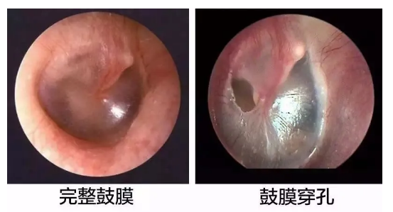 重庆鼓膜穿孔