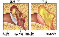 中耳炎的类型有哪些？有什么注意事项