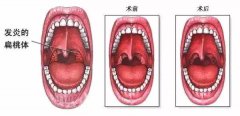 扁桃体炎的症状表现有哪些？重庆耳鼻喉医院