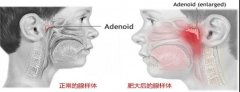 腺样体肥大到底是种什么病？腺样体肥大有哪些症状