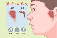 腺样体肥大的症状有哪些？重庆三级耳鼻喉专科医院