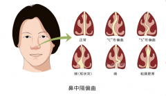 鼻中隔偏曲一定要手术吗