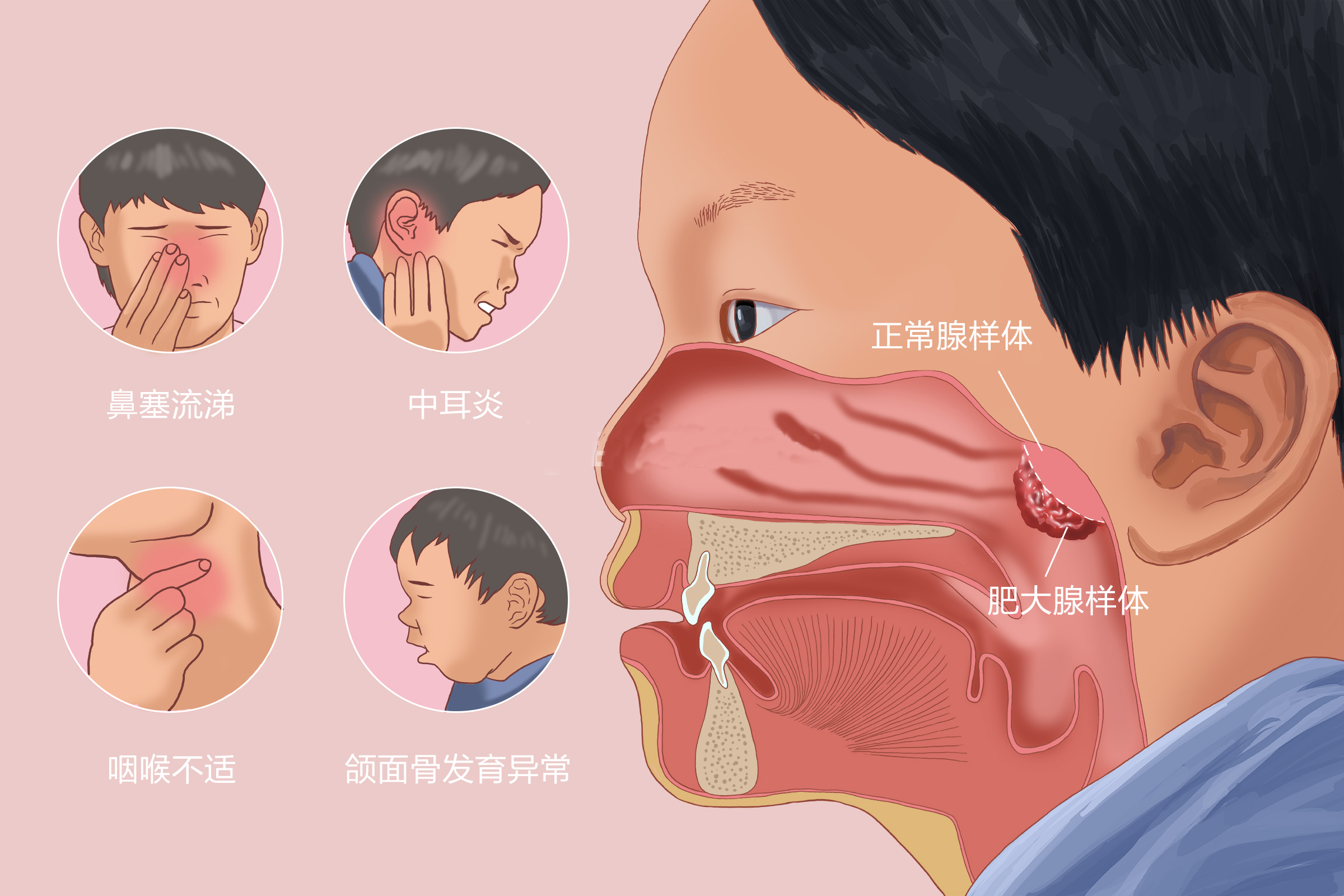 重庆治疗腺样体肥大医院