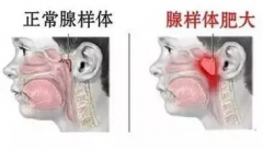 是什么原因导致现在腺样体肥大的孩子越来越多？